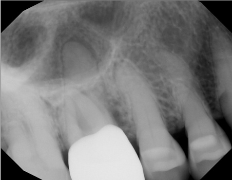 Connective Tissue Grafting on Anterior Teeth Using a Modified VISTA Technique